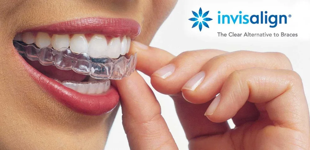 A clear Invisalign aligner being placed over teeth, with the Invisalign logo and the words The Clear Alternative to Braces